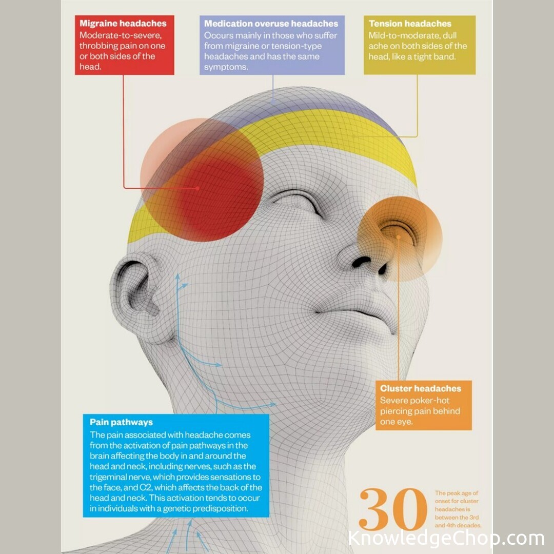 Headache: a visual guide - The Pharmaceutical Journal | 🥷 Knowledge Ninja