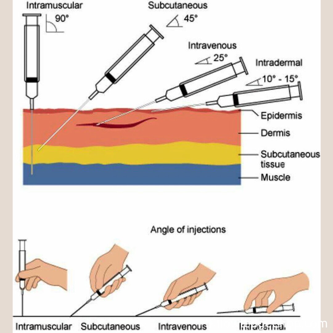 💉 Different types of injection: Intramuscular (IM) Subcutaneous (SC) Intravenous (IV) Intradermal (ID)